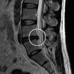Image result for lumbar mri disc bulge